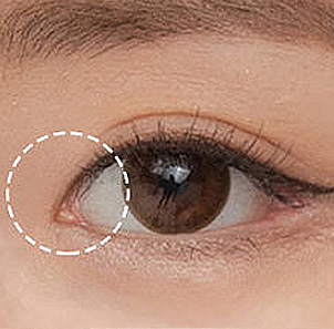 Step 1 measuring the degree of individual Mongolian folds for front canthoplasty design at NANA
