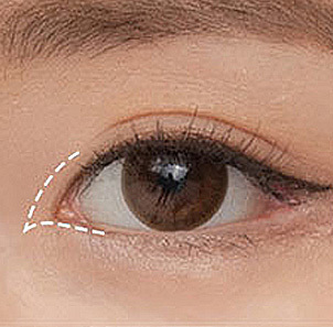Step 2 designing a tailored plan based on Mongolian fold degree and double eyelid line at NANA