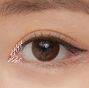 Step 4 repositioning skin according to the desired anterior line and suturing delicately at NANA
