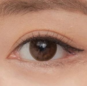 Step 5 completed larger refreshed eyes after front canthoplasty Mongolian fold removal at NANA