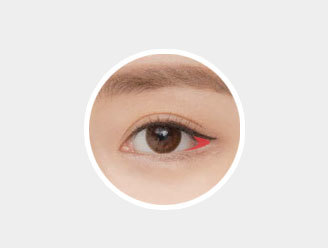 General lateral canthoplasty focusing on a single area resulting in imbalanced unnatural appearance