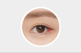 General lateral canthoplasty focusing on a single area resulting in imbalanced unnatural appearance