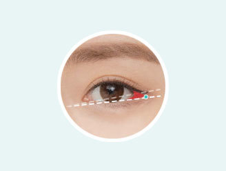 NANA lateral canthoplasty considering eye horizontal length vertical height and angle for natural enlargement