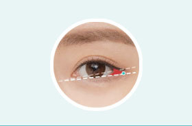 NANA lateral canthoplasty considering eye horizontal length vertical height and angle for natural enlargement
