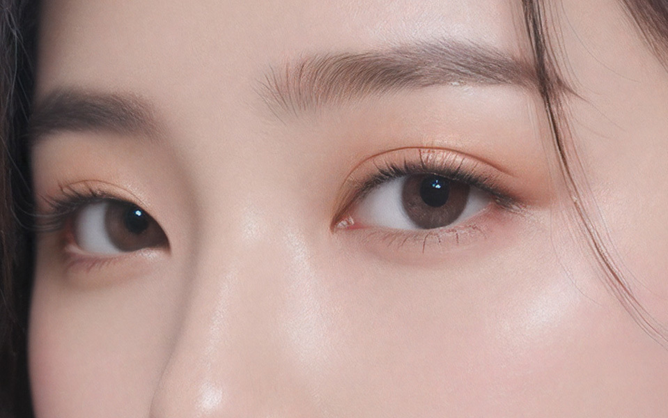 Before and after lateral canthoplasty with periosteum fixation preventing recurrence at NANA Korea
