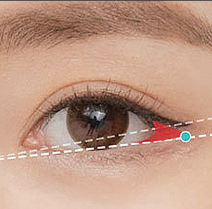 Step 2 creating a 1 to 2mm incision at the designed outer corner angle in lateral canthoplasty at NANA
