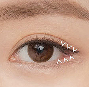 Step 3 securely fixing the periosteum of the incised outer corner area in lateral canthoplasty at NANA