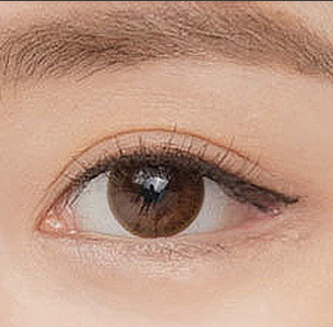 Step 4 creating a natural distinct eye shape with no visible scars after lateral canthoplasty at NANA
