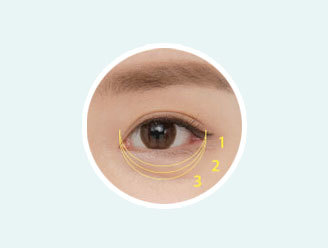 Step-by-step outer corner angle adjustment in lower canthoplasty for personalized eye shape at NANA