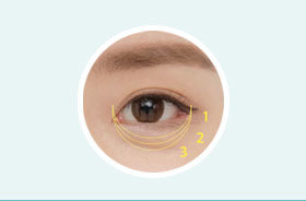 Step-by-step outer corner angle adjustment in lower canthoplasty for personalized eye shape at NANA