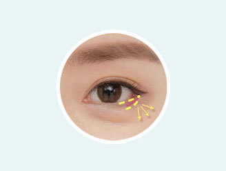 Correction of uneven eyes and asymmetry through lower canthoplasty at NANA Plastic Surgery Korea
