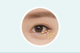 Correction of uneven eyes and asymmetry through lower canthoplasty at NANA Plastic Surgery Korea