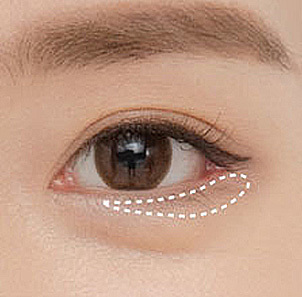 Step 1 designing a customized line for lowering the outer corner of the eye in canthoplasty at NANA