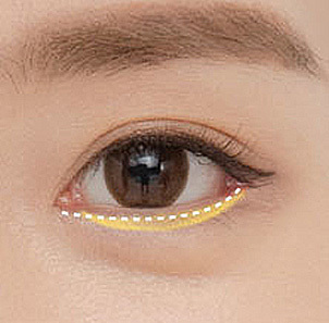 Step 2 incising the lower eyelid conjunctiva to locate and secure the desired muscle at NANA