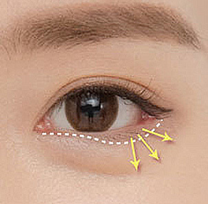 Step 3 placing fixation points on muscle and tarsal plate to create a gentle lower eyelid S-line at NANA