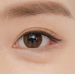Step 4 suturing the conjunctiva to create a natural aegyo line without visible scarring at NANA