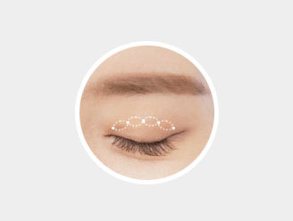 Conventional buried non-incision suture method creating 3–5 grooves with knots at NANA Plastic Surgery