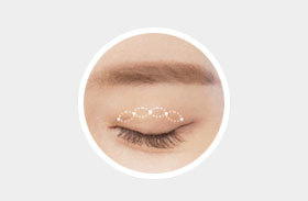 Conventional buried non-incision suture method creating 3–5 grooves with knots at NANA Plastic Surgery