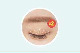 NANA Natural Adhesion Buried Non-Incision Suture Method creating 5–7 grooves with dual-lock knot technique