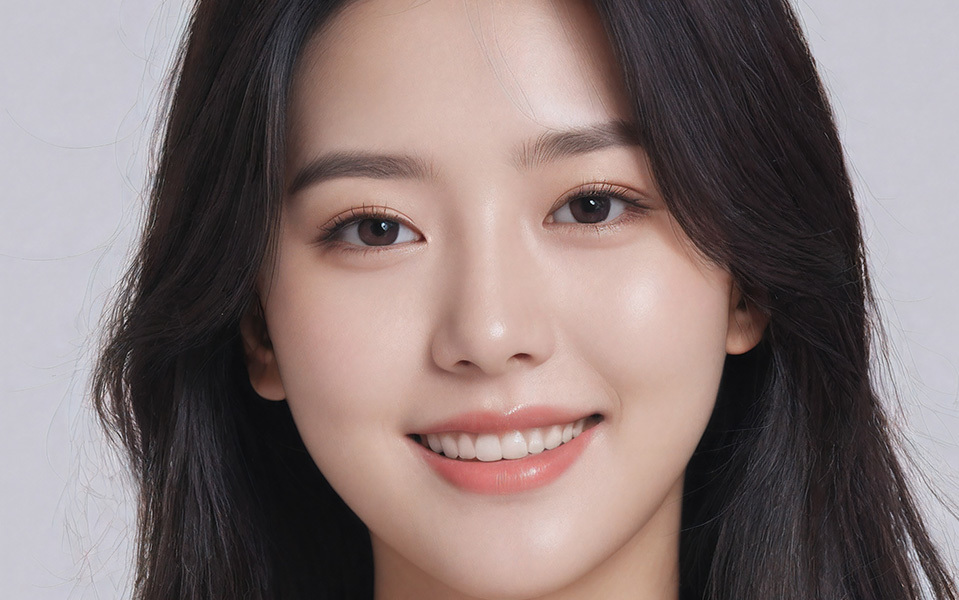 Natural adhesion buried non-incision double eyelid surgery result showing natural distinct double eyelid line at NANA