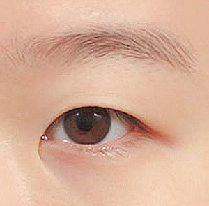 Step 1 designing the desired double eyelid line according to individual preferences at NANA