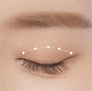 Step 2 making minimal incisions in 5–7 areas along the designed double eyelid line at NANA