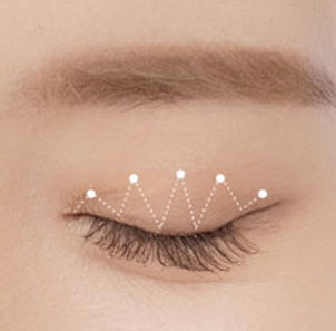 Step 4 passing the thread continuously through the skin and conjunctiva to create the double eyelid line at NANA