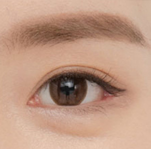 Step 5 completed natural and distinct double eyelid line after buried non-incision suture method at NANA