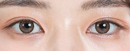 Customized in-out double eyelid line for Asians blending inner and outer lines for a unique look at NANA