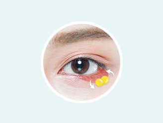 Under eye fat repositioning reshaping existing fat for lower risk of fat loss at NANA Plastic Surgery