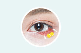Under eye fat repositioning reshaping existing fat for lower risk of fat loss at NANA Plastic Surgery