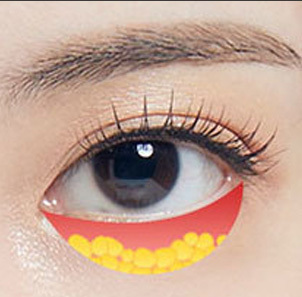 Under eye fat repositioning reducing bulging fat while filling tear troughs and improving dark circles at NANA