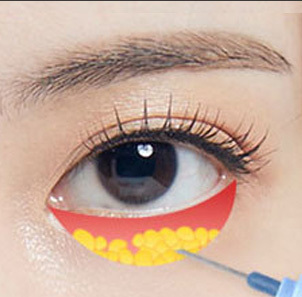 Under eye fat removal for cases where only under-eye fat is significantly protruding at NANA