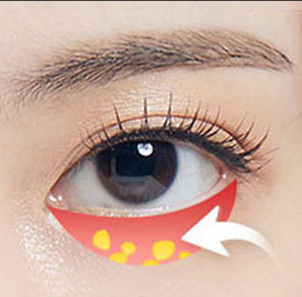 Under eye fat grafting combined with repositioning for insufficient fat or general lack of volume at NANA