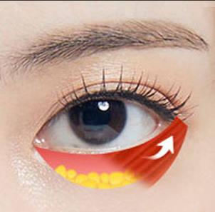 Lower blepharoplasty combining fat repositioning with under-eye lifting and sagging skin removal at NANA