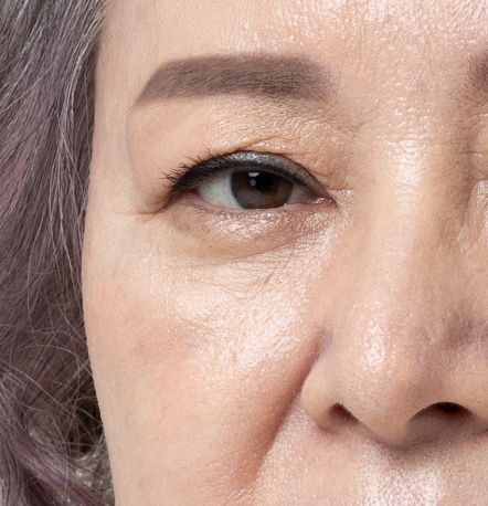 Mid facelift case 2 bulging fat under the eyes resulting in deep wrinkles at NANA Plastic Surgery
