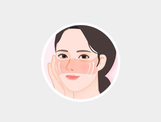 Comprehensive correction of under-eye wrinkles and cheek sagging with mid facelift at NANA