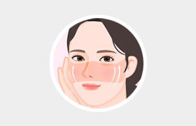 Comprehensive correction of under-eye wrinkles and cheek sagging with mid facelift at NANA