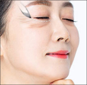 Step 1 small incision made beneath the eyes for mid facelift surgery at NANA Plastic Surgery