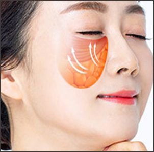 Step 2 lifting entire tissue including fascia layer back to original position in mid facelift at NANA