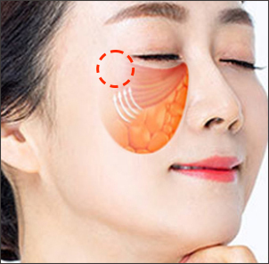 Step 3 securing lifted tissues with sutures and adjusting fat position in mid facelift at NANA