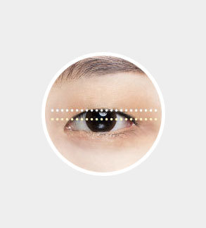 Eyes requiring ptosis correction with 2mm or less of the eye center exposed at NANA