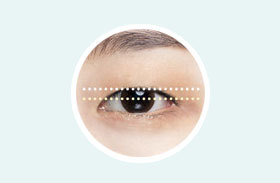 Eyes requiring ptosis correction with 2mm or less of the eye center exposed at NANA