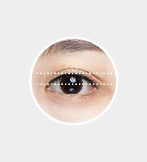 Eyes with normal pupil exposure of approximately 5mm from center used as reference for ptosis correction at NANA