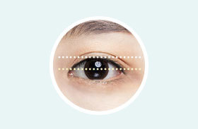 Eyes with normal pupil exposure of approximately 5mm from center used as reference for ptosis correction at NANA