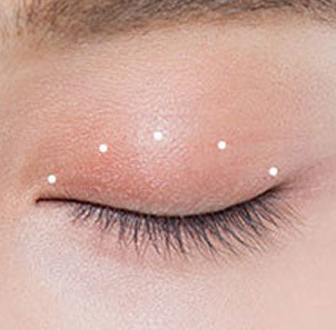 Step 1 designing desired double eyelid line based on individual preferences for ptosis correction at NANA
