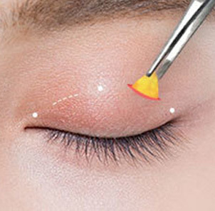 Step 2 removing unnecessary muscles or fat along the designed incision line for ptosis correction at NANA