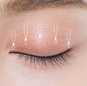 Step 3 tightening and suturing the eye-opening levator muscle to desired strength in ptosis correction at NANA