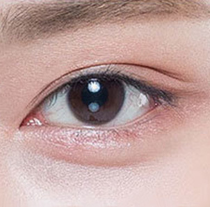 Step 4 achieving a natural and clearly defined eye shape after ptosis correction at NANA Plastic Surgery