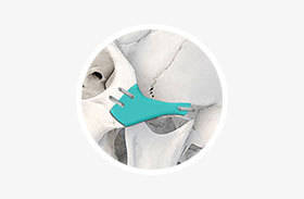 Zygoma reduction feature double fixation for non-union prevention at NANA Plastic Surgery Korea